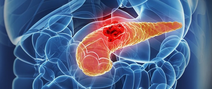 Tratament cancer pancreatic in sectia de Chimioterapie (Prezentare caz)